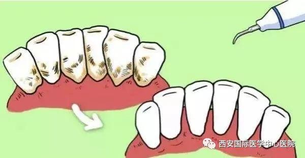 【科普】牙齒上的黃斑好難看，三招告訴你如何預(yù)防氟斑牙