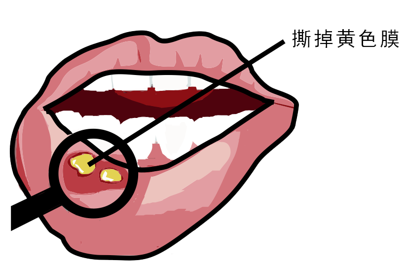 經(jīng)常口腔潰瘍，真的只是缺維生素嗎？