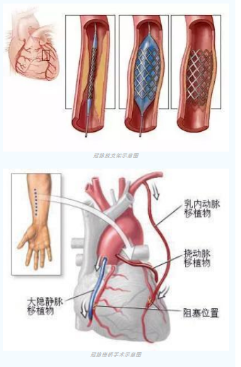 魚與熊掌不可兼得？冠脈雜交手術(shù)一站式解決問題