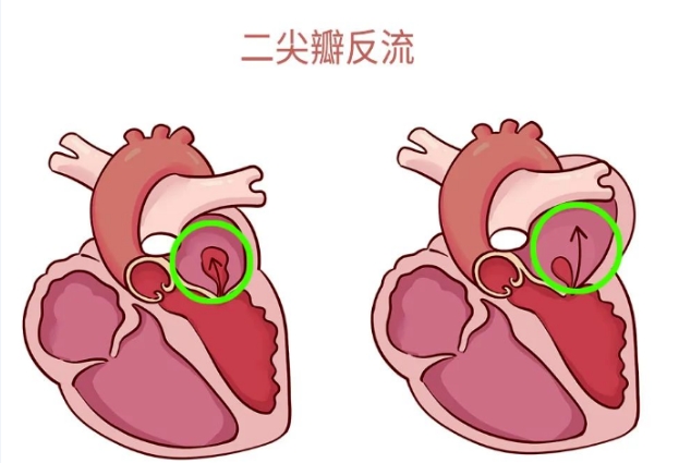 體檢報(bào)告里的心臟瓣膜返流，你讀懂了嗎？